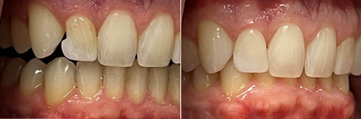 A before and after picture of a person 's teeth.