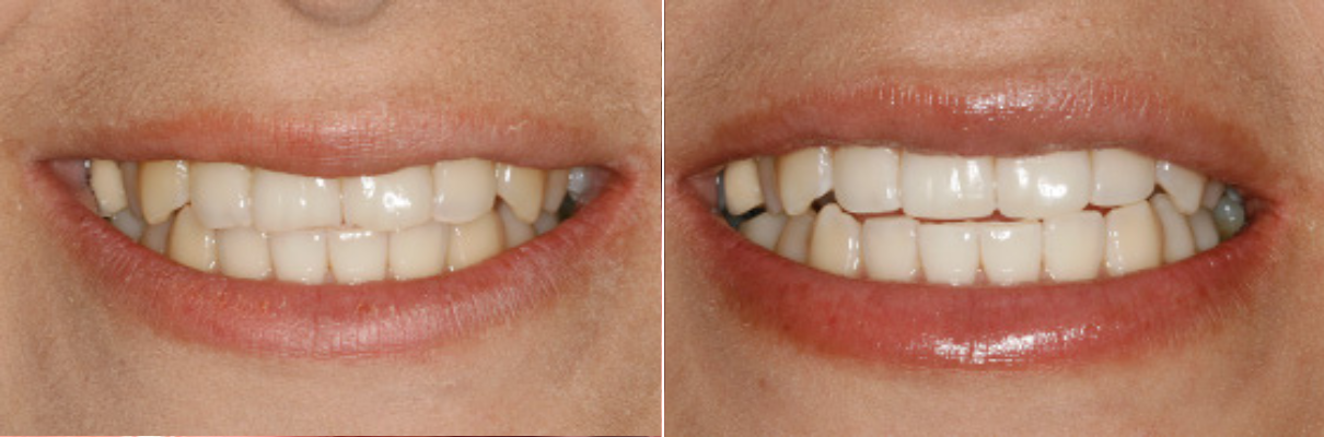 A before and after picture of a woman 's teeth.