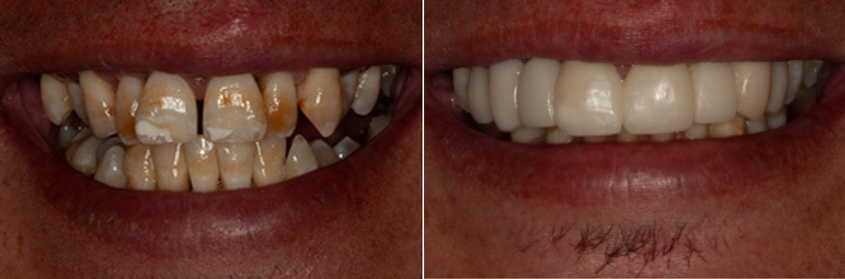 A before and after picture of a person 's teeth.