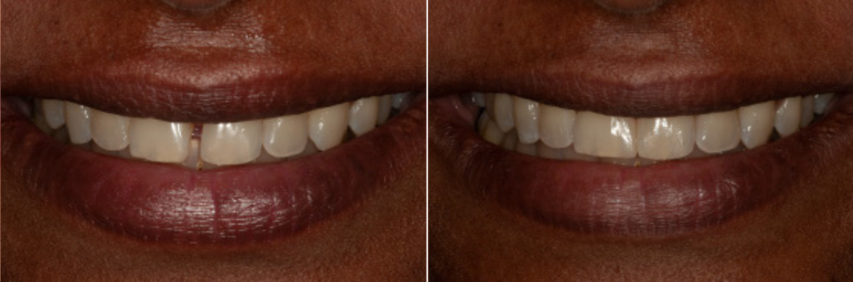 A before and after picture of a woman 's smile with white teeth.