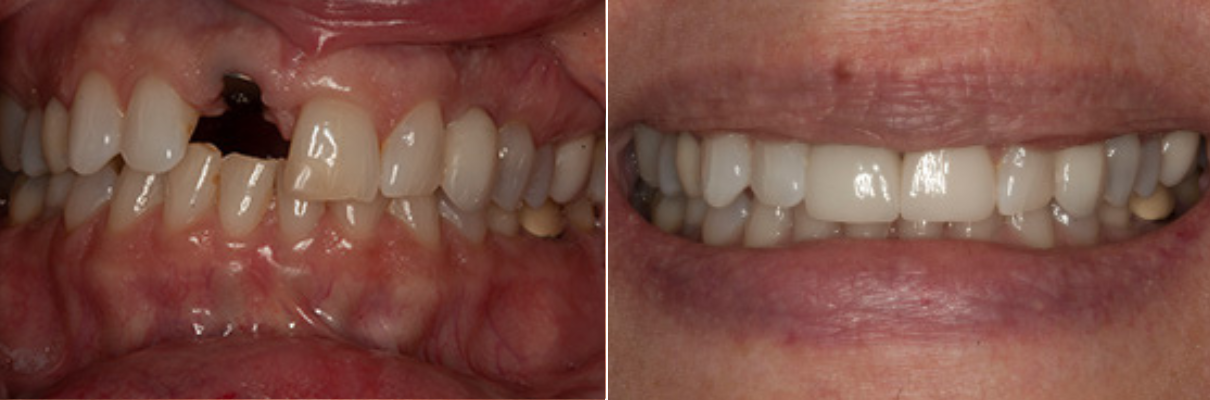 A before and after picture of a person 's teeth.