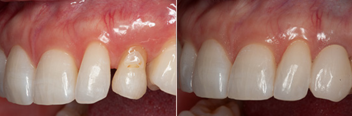 A before and after picture of a person 's teeth.