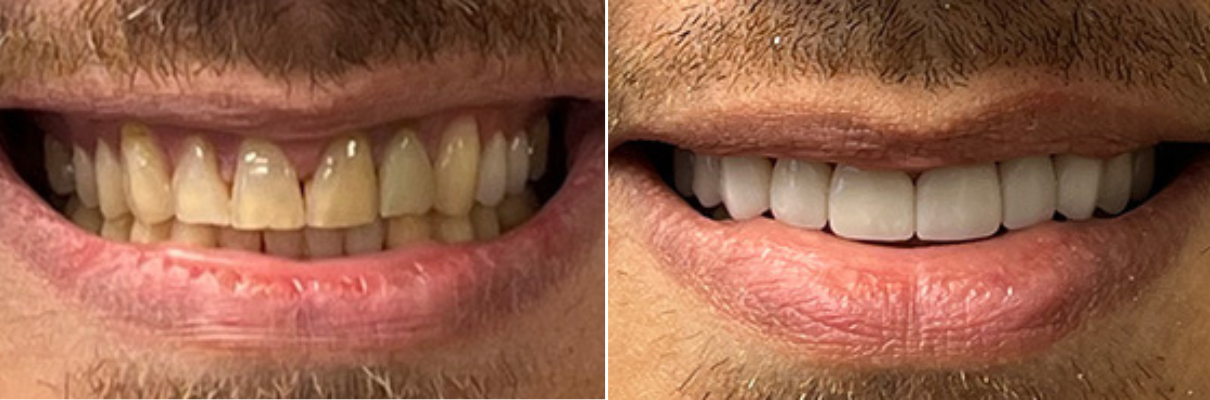 A before and after picture of a man 's teeth.
