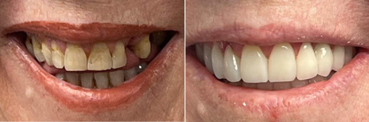 A before and after picture of a woman 's teeth.