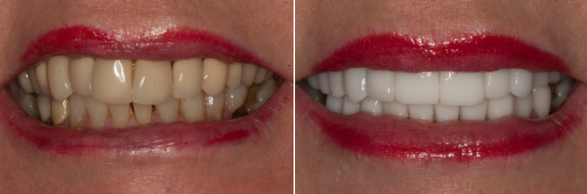 A before and after picture of a woman 's teeth with red lipstick