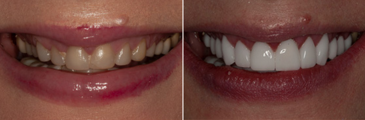 A before and after picture of a woman 's teeth.