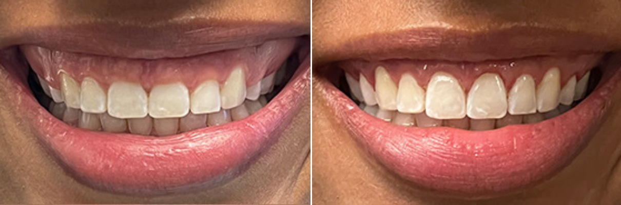 A before and after picture of a woman 's teeth.