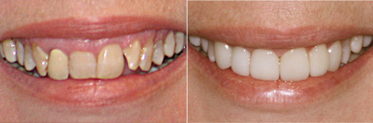 A before and after picture of a woman 's teeth.