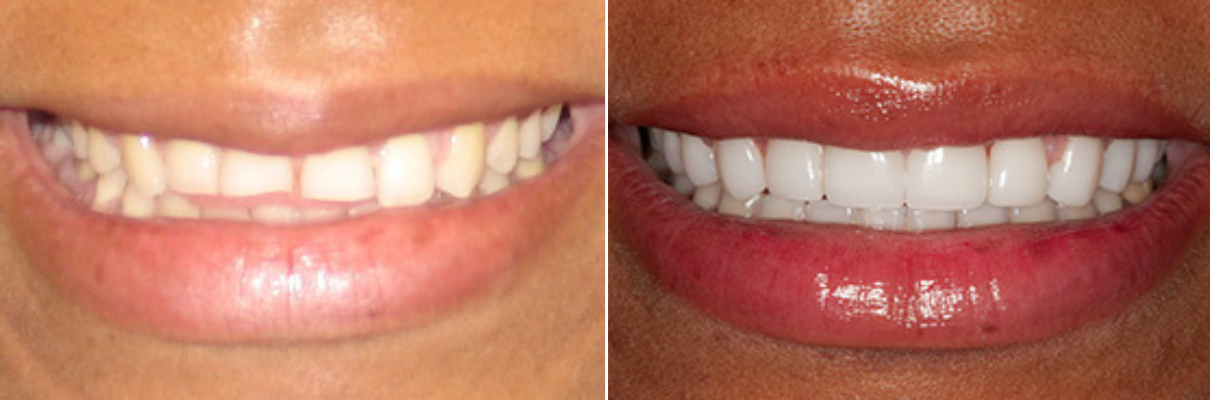 A before and after picture of a woman 's teeth and lips.
