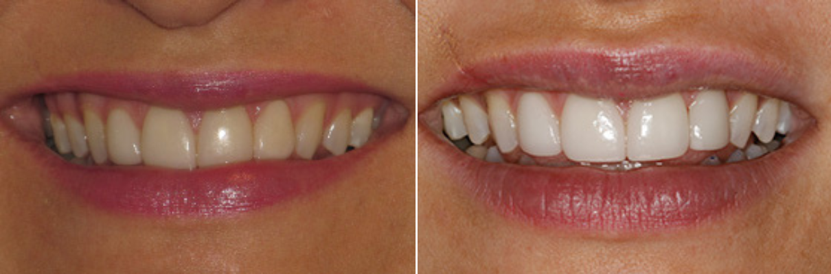 A before and after picture of a woman 's teeth.