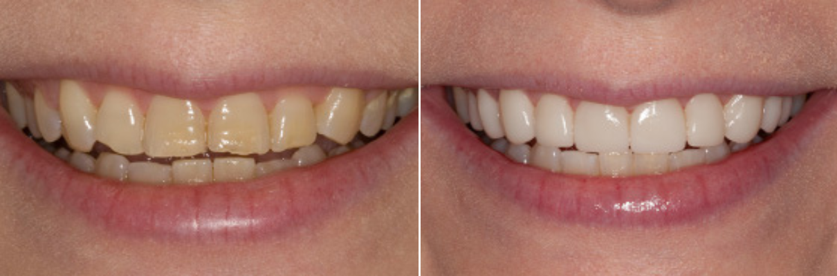 A before and after picture of a woman 's teeth.