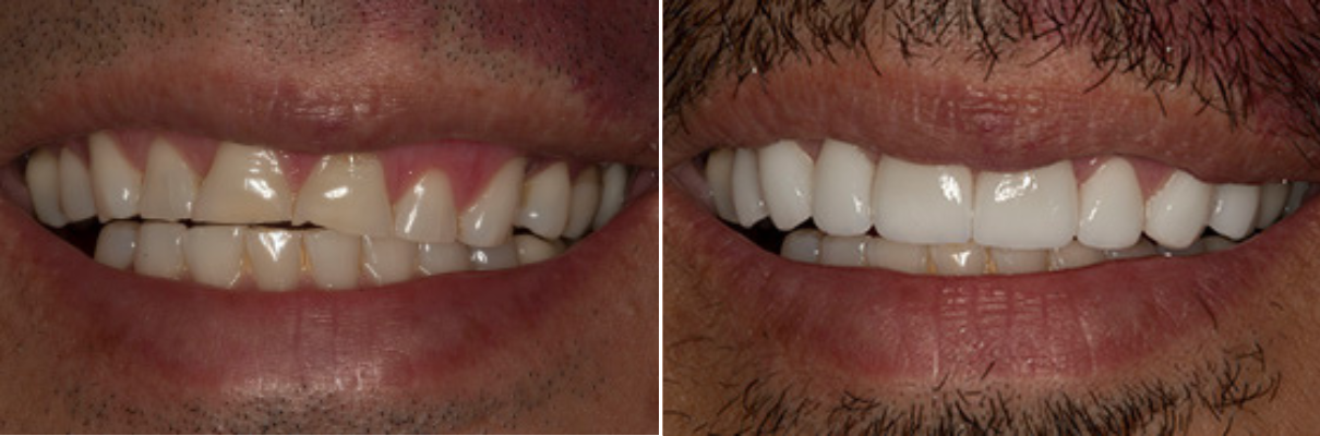 A before and after picture of a man 's teeth.