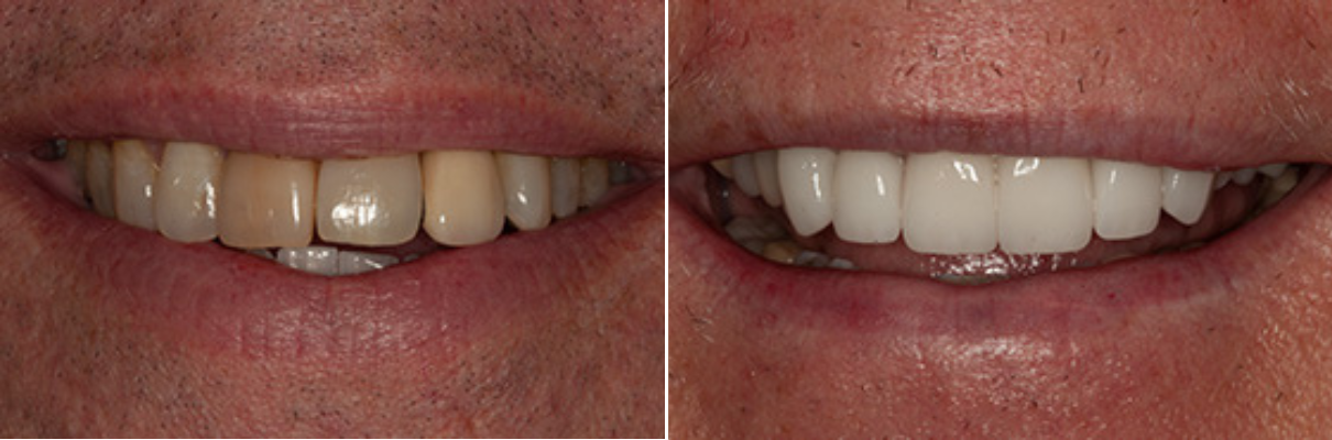A before and after picture of a man 's teeth.