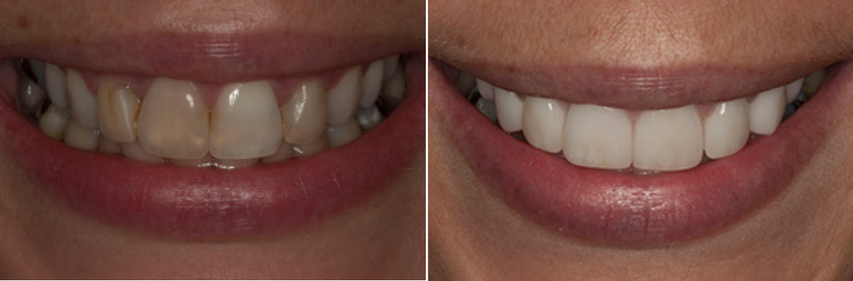 A before and after photo of a woman 's teeth.