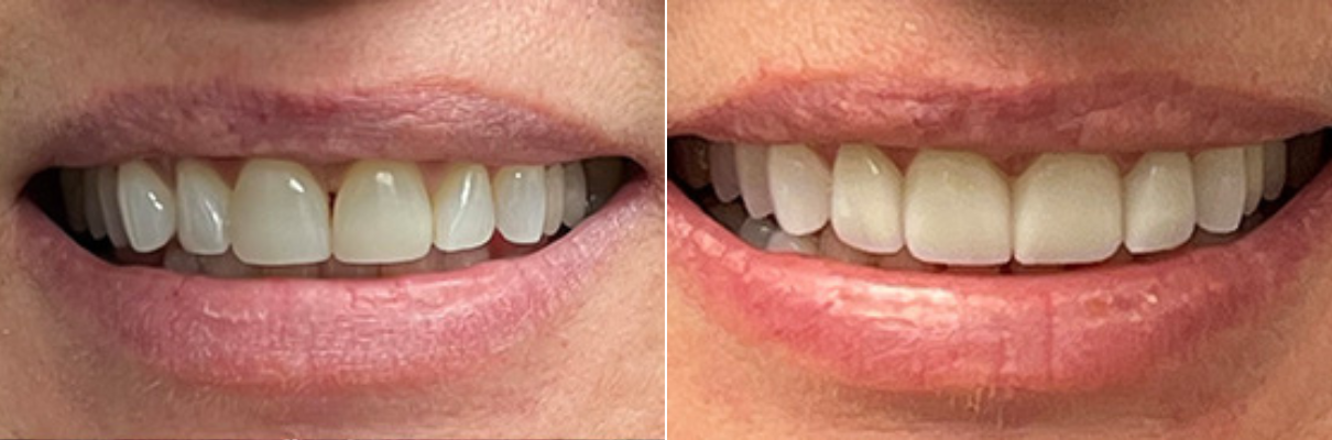 Before and after photos of a smile showing dental correction of gaps and tooth alignment.