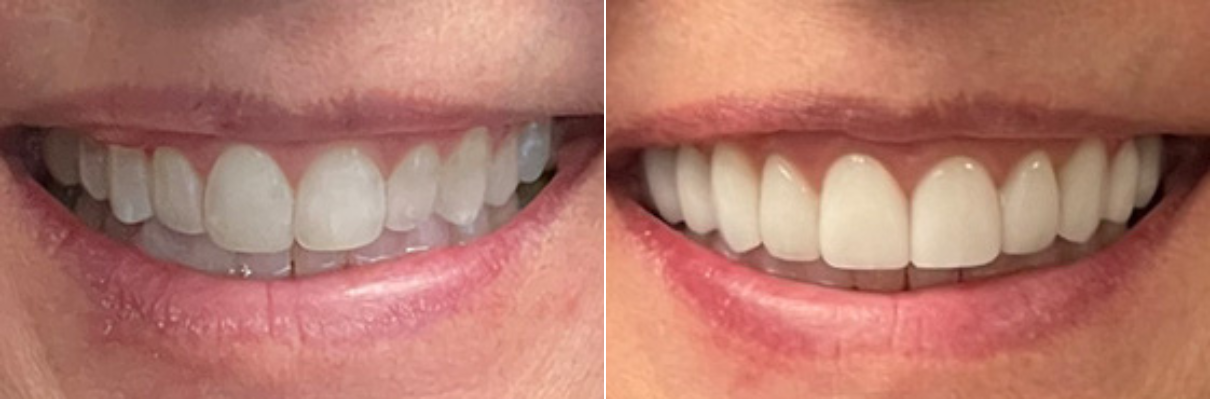 A before and after picture of a woman 's teeth.