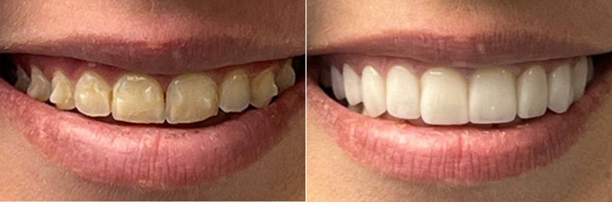 A before and after picture of a woman 's teeth.
