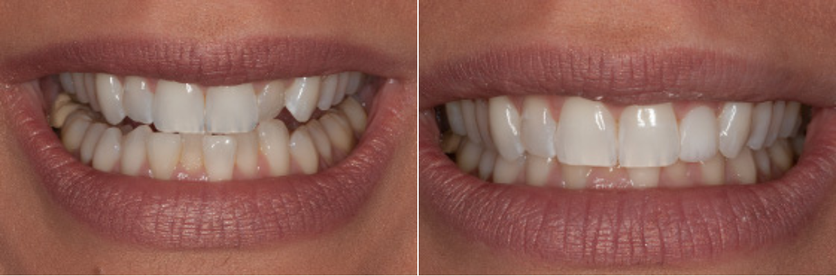 A before and after picture of a woman 's teeth.
