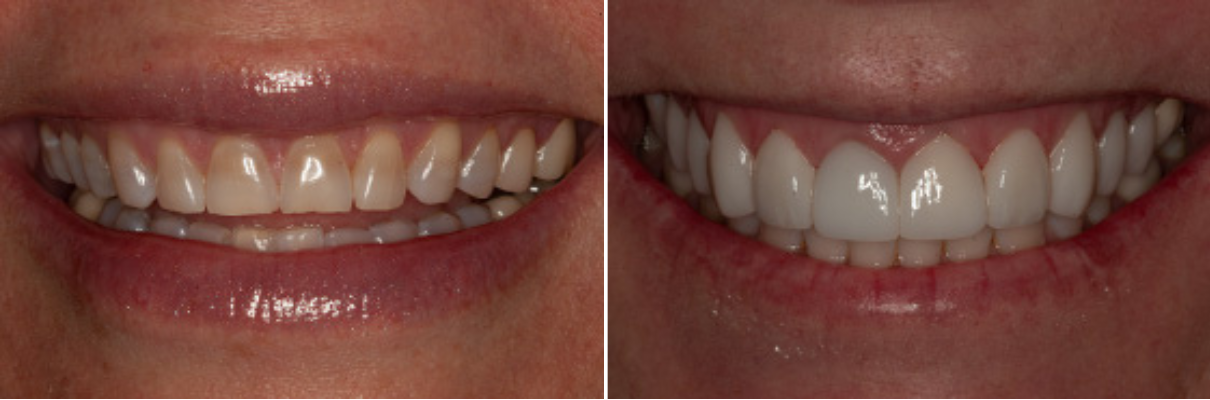 A before and after picture of a woman 's teeth
