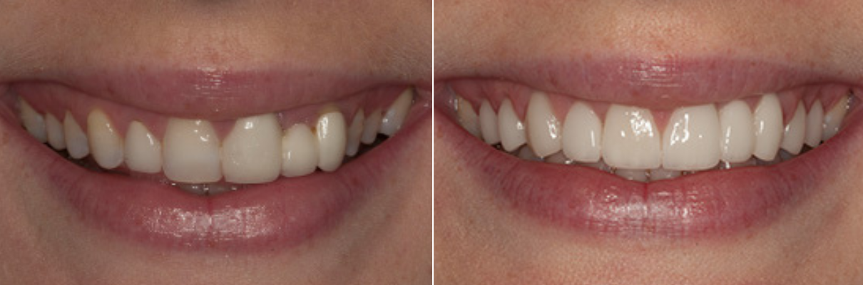 A before and after picture of a woman 's teeth.