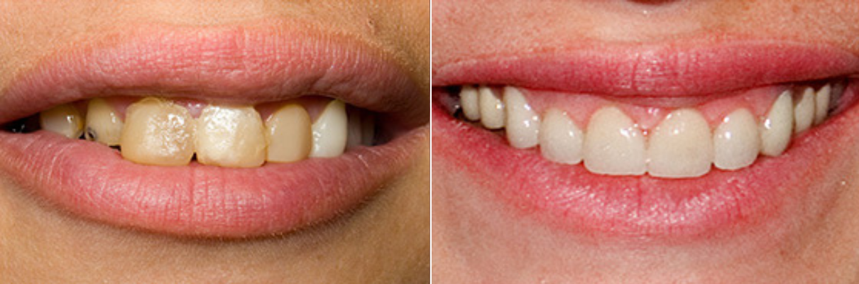 A before and after picture of a woman 's teeth.
