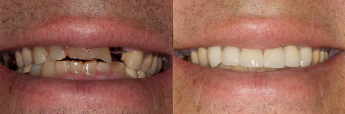 A before and after picture of a man 's teeth.