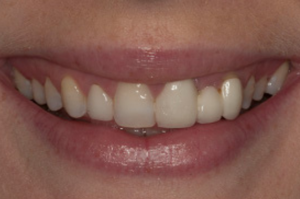 A close up of a woman 's mouth with a broken tooth.