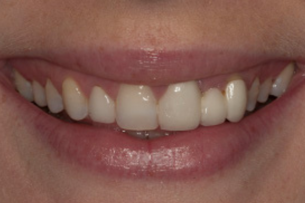 A close up of a woman 's mouth with a broken tooth.