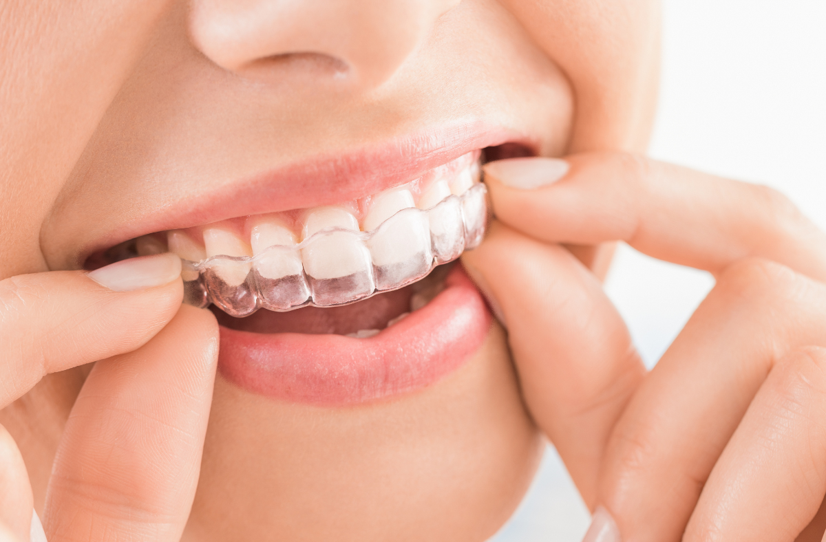 Person inserting clear aligners into their mouth.