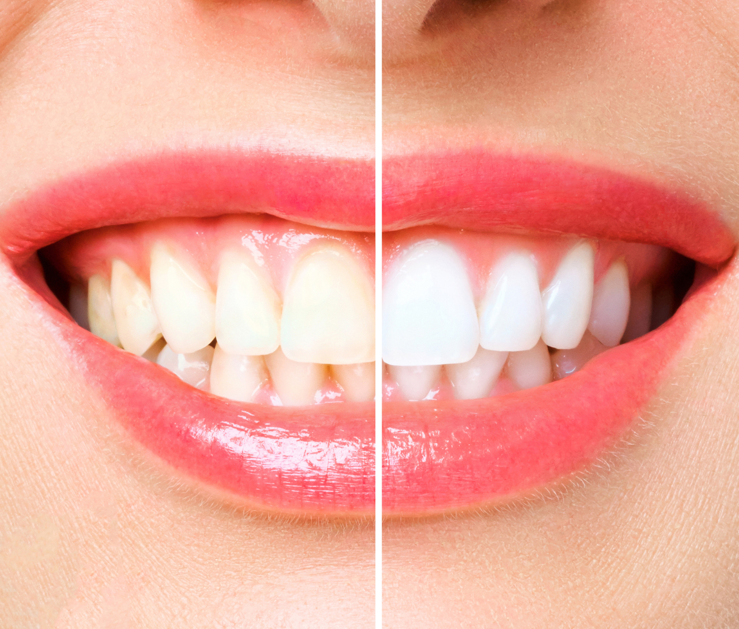 Close-up of teeth showing a whitening transformation