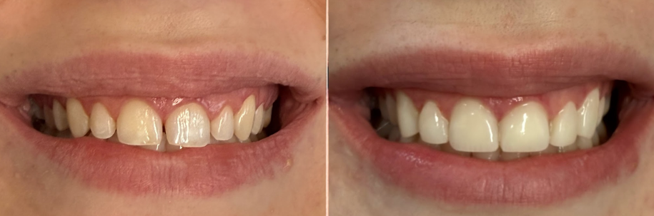 Before and after dental veneers results at Austin Elite Smiles in Austin, TX