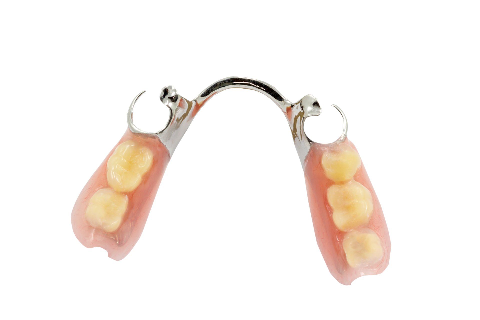 Prothèse partielle avec gencives roses et trois dents prothétiques de chaque côté, reliées par une barre métallique.