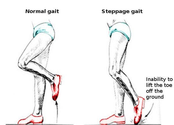Spastic Gait