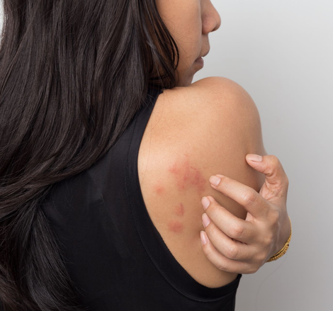 hives on skin - allergy treatment in maryland
