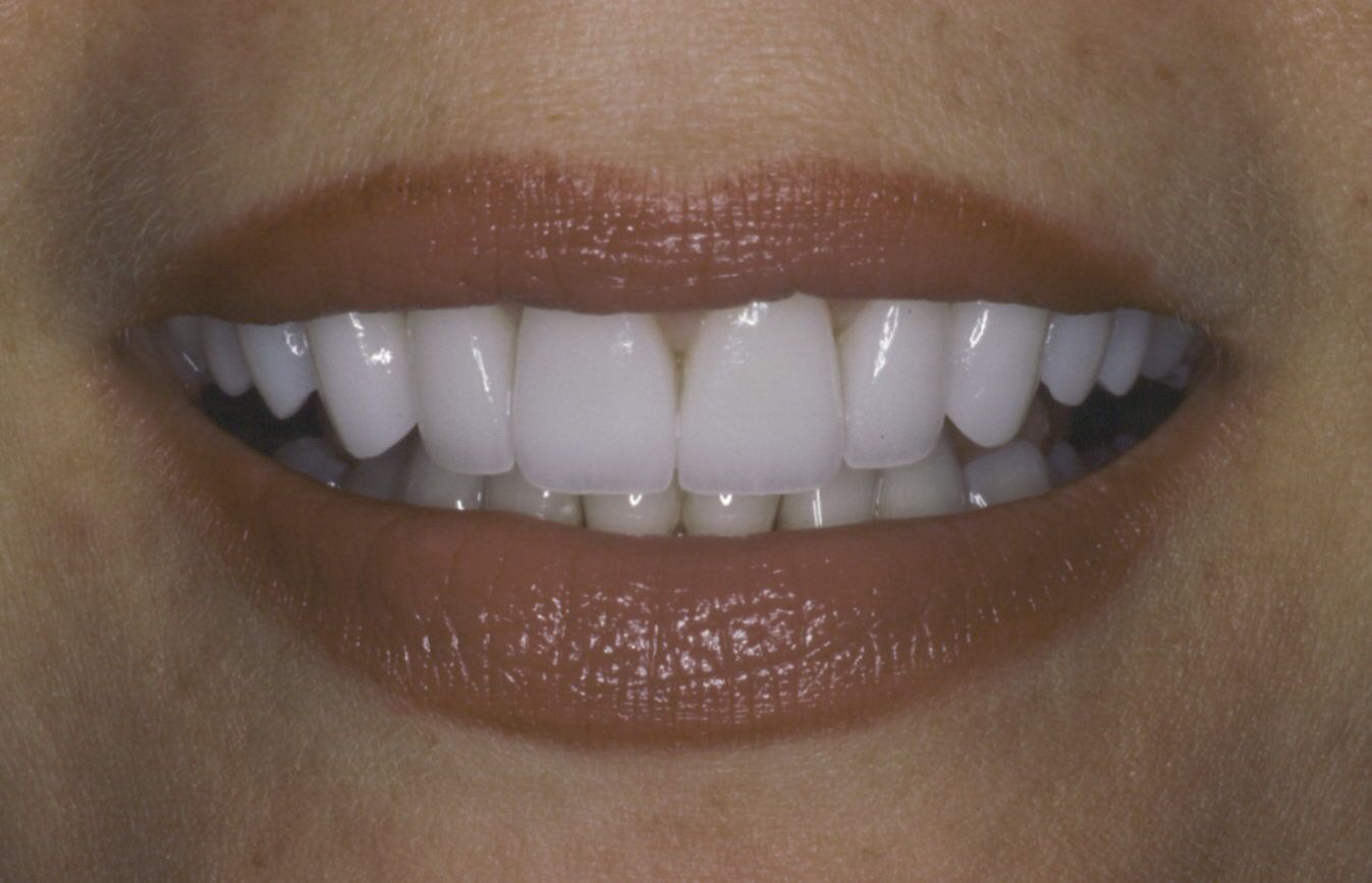 veneers after Upstate Smiles