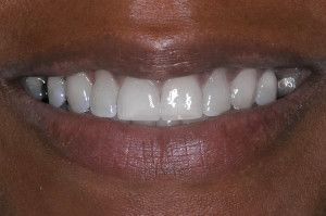 Upstate smiles dental service