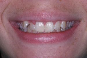 Upstate smiles dental service
