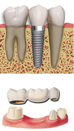 Dental implant supporting a three-unit bridge over missing teeth, with top and lower jaw illustrations.