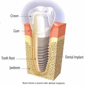 Dental implant diagram showing crown, gum, tooth root, jawbone, and implant cross-section with labels