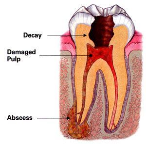 Diagram of a decayed tooth with damaged pulp and an abscess at the root