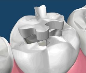 Close-up of a white molar with a silver dental filling or crown