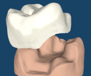 3D dental model showing a white crown aligned above a tan tooth base