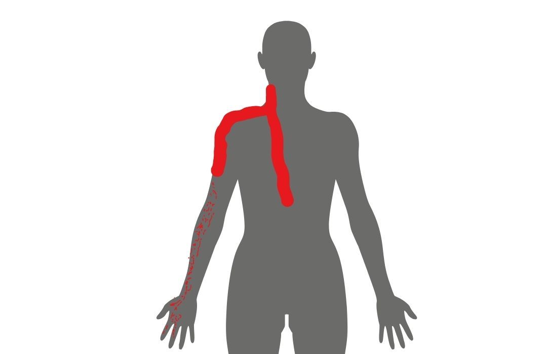 Kube Medical | Neck Pain from Disc Issue