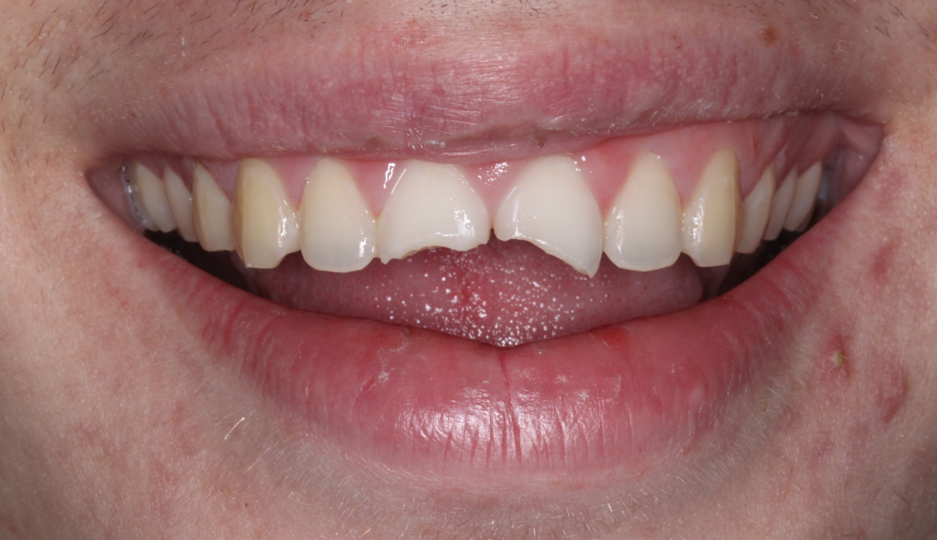 Before fixing chipped tooth with dental crown | Same day emergency dentist in Escondido CA 92026