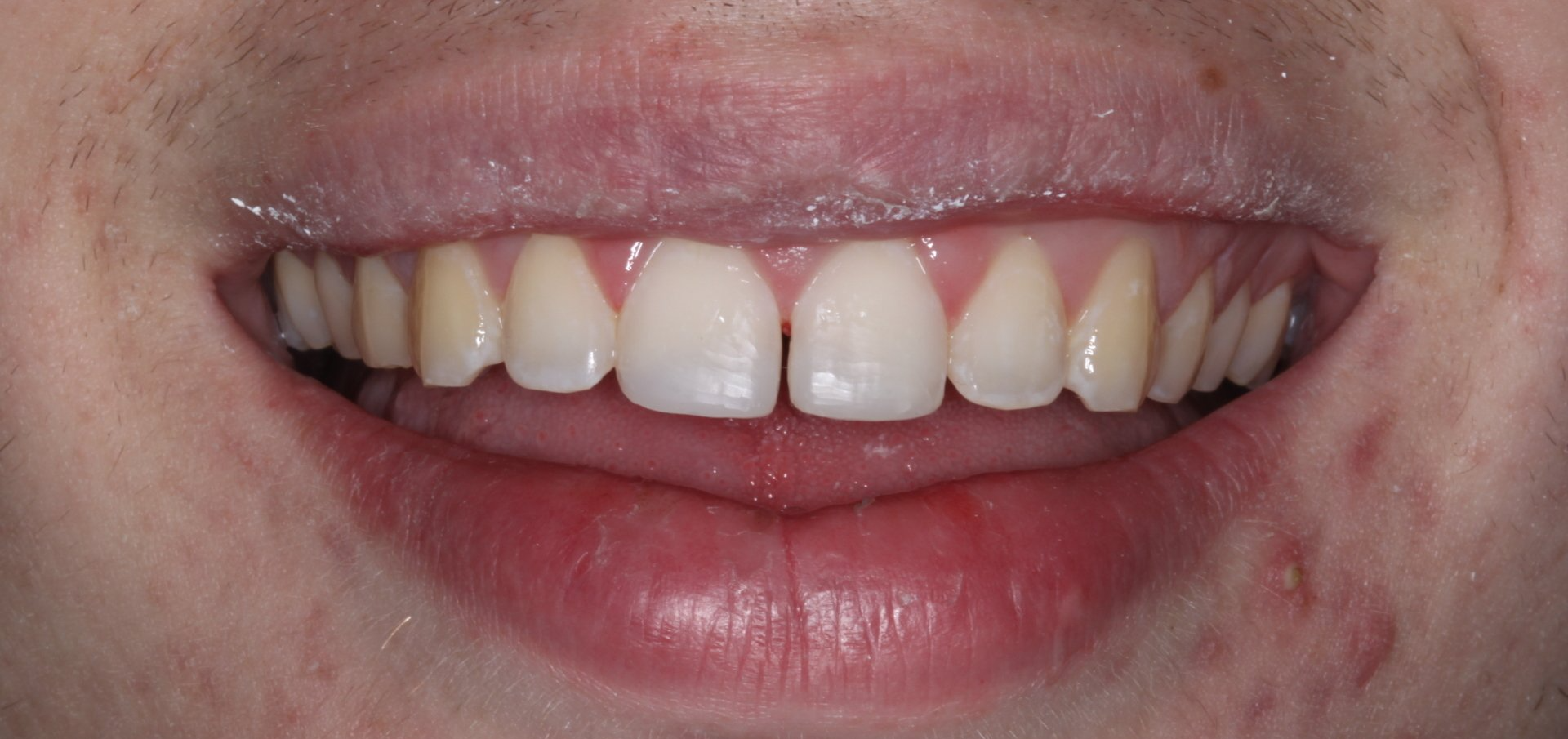 After fixing chipped tooth with our dental crowns | Same Day Emergency Dentist in Escondido CA 92026