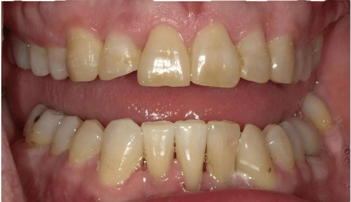 teeth after