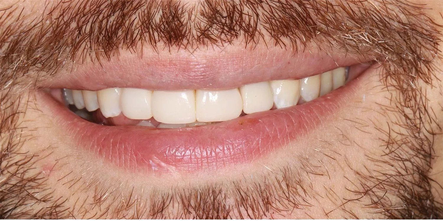 teeth after
