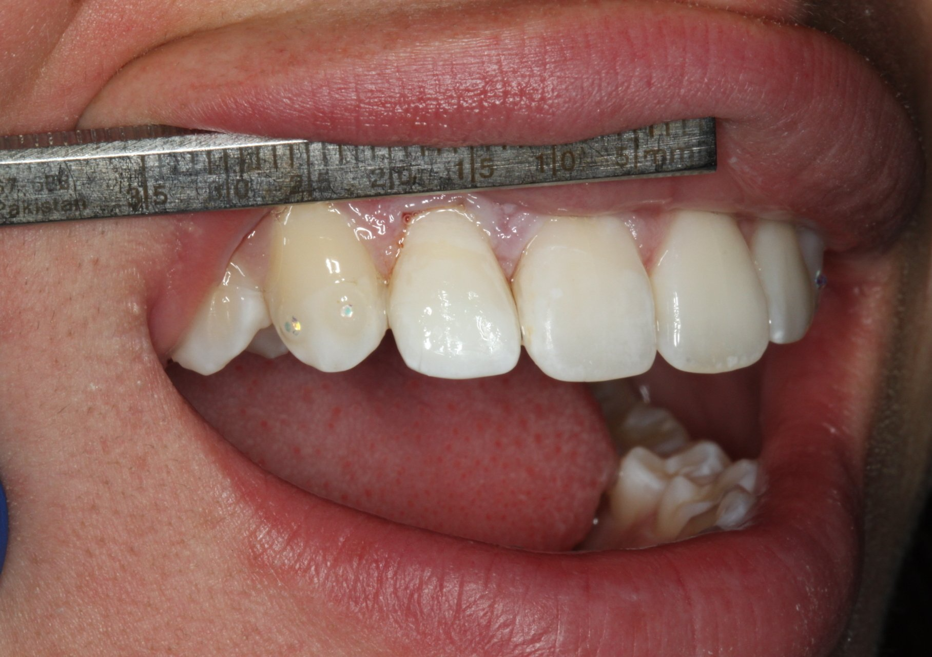 After dental crown replacing cracked tooth | Escondido CA 92026 same day emergency dentist