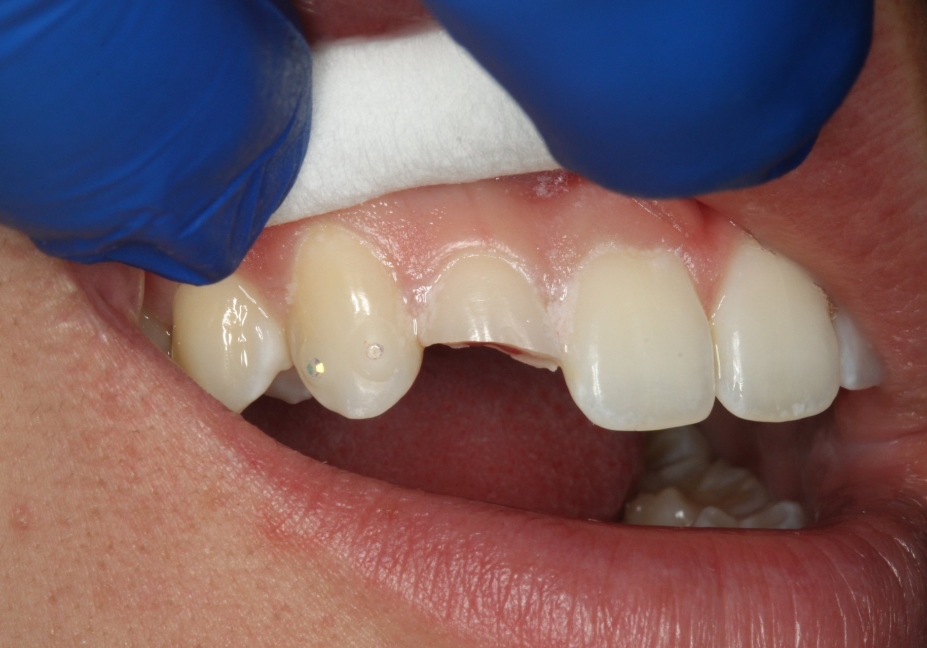 Before same day emergency dental crown | Chipped tooth | Escondido Dentist 92026
