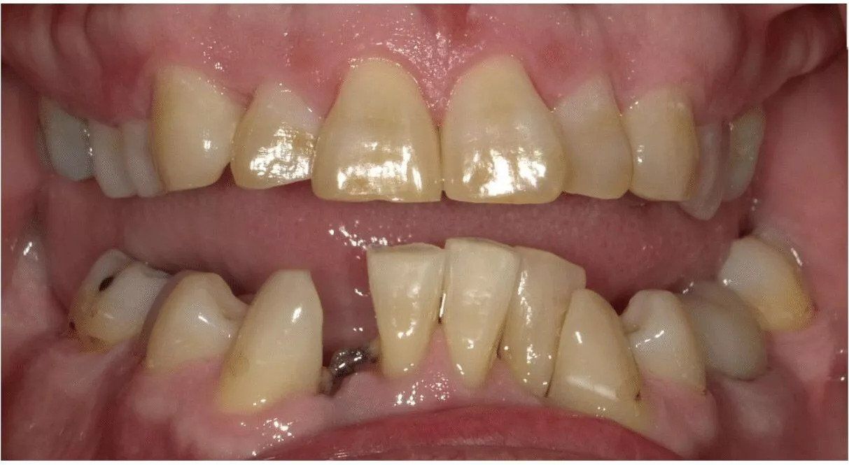 teeth before